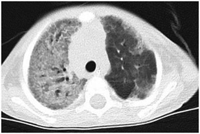 Respiratory tract infection of fatal severe human bocavirus 1 in a 13-month-old child: A case report and literature review